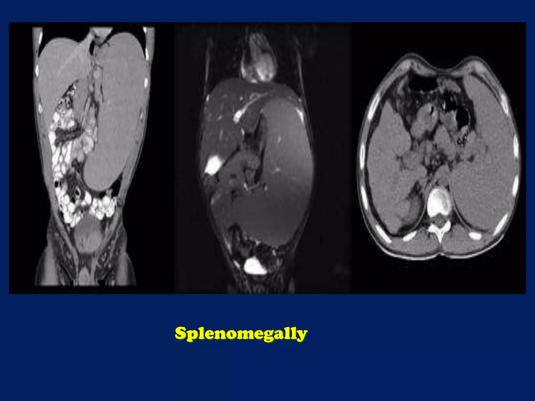 Splenomegally