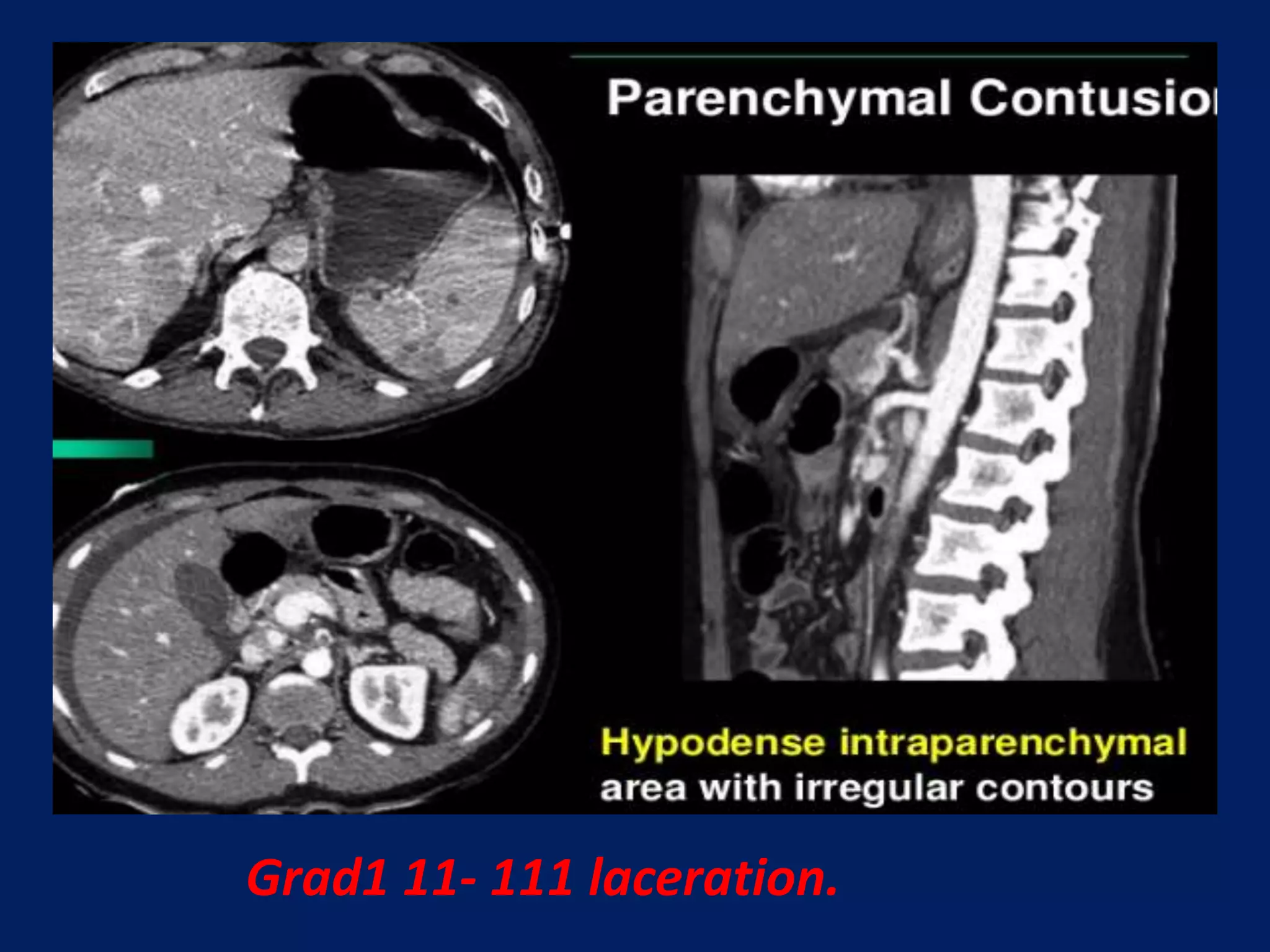 Grad1 11- 111 laceration.