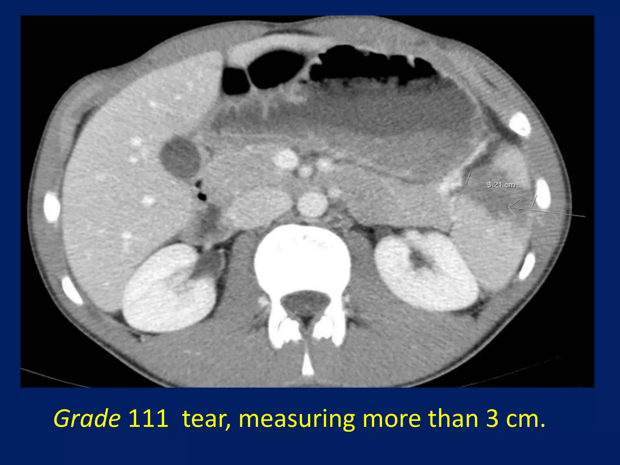 Grade 111 tear, measuring more than 3 cm.