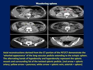 Axial reconstructions derived from the CT portion of the PET/CT demonstrate the
‘whorled-appearance’ of the long vascular pedicle extending to the ectopic spleen.
The alternating bands of hypodensity and hyperdensity represent the splenic
vessels and surrounding fat of the twisted splenic pedicle. [red arrow = splenic
artery; yellow arrow = pancreas; white arrow = splenic vein; asterisk = spleen]
Wandering spleen
 