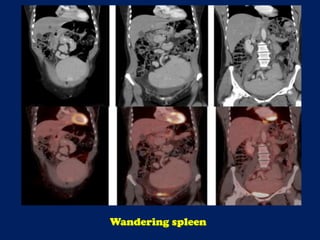 Wandering spleen
 