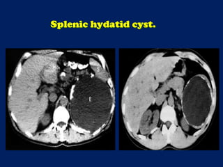 Splenic hydatid cyst.
 