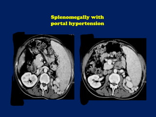 Splenomegally with
portal hypertension
 
