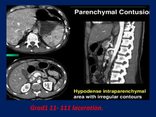 Grad1 11- 111 laceration.
 