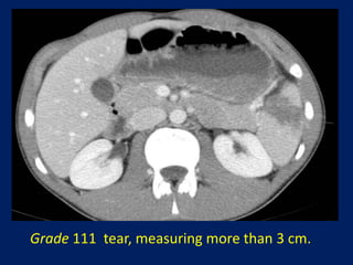 Grade 111 tear, measuring more than 3 cm.
 