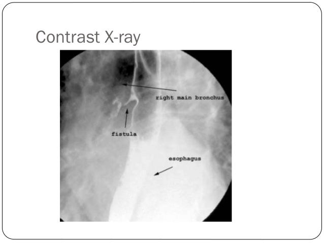 Acquired Tracheo-esophageal fistula