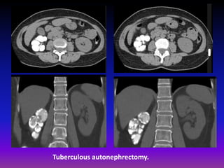 Tuberculous autonephrectomy.
 