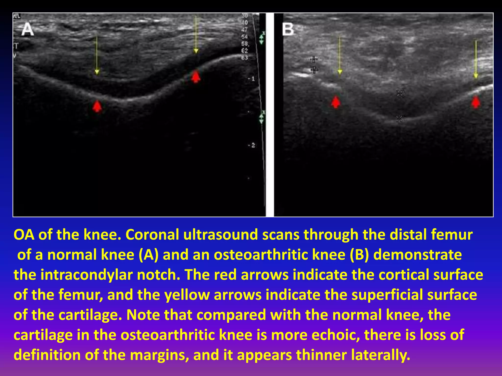 OA of the knee. Coronal ultrasound scans through the distal femur
of a normal knee (A) and an osteoarthritic knee (B) demonstrate
the intracondylar notch. The red arrows indicate the cortical surface
of the femur, and the yellow arrows indicate the superficial surface
of the cartilage. Note that compared with the normal knee, the
cartilage in the osteoarthritic knee is more echoic, there is loss of
definition of the margins, and it appears thinner laterally.
 