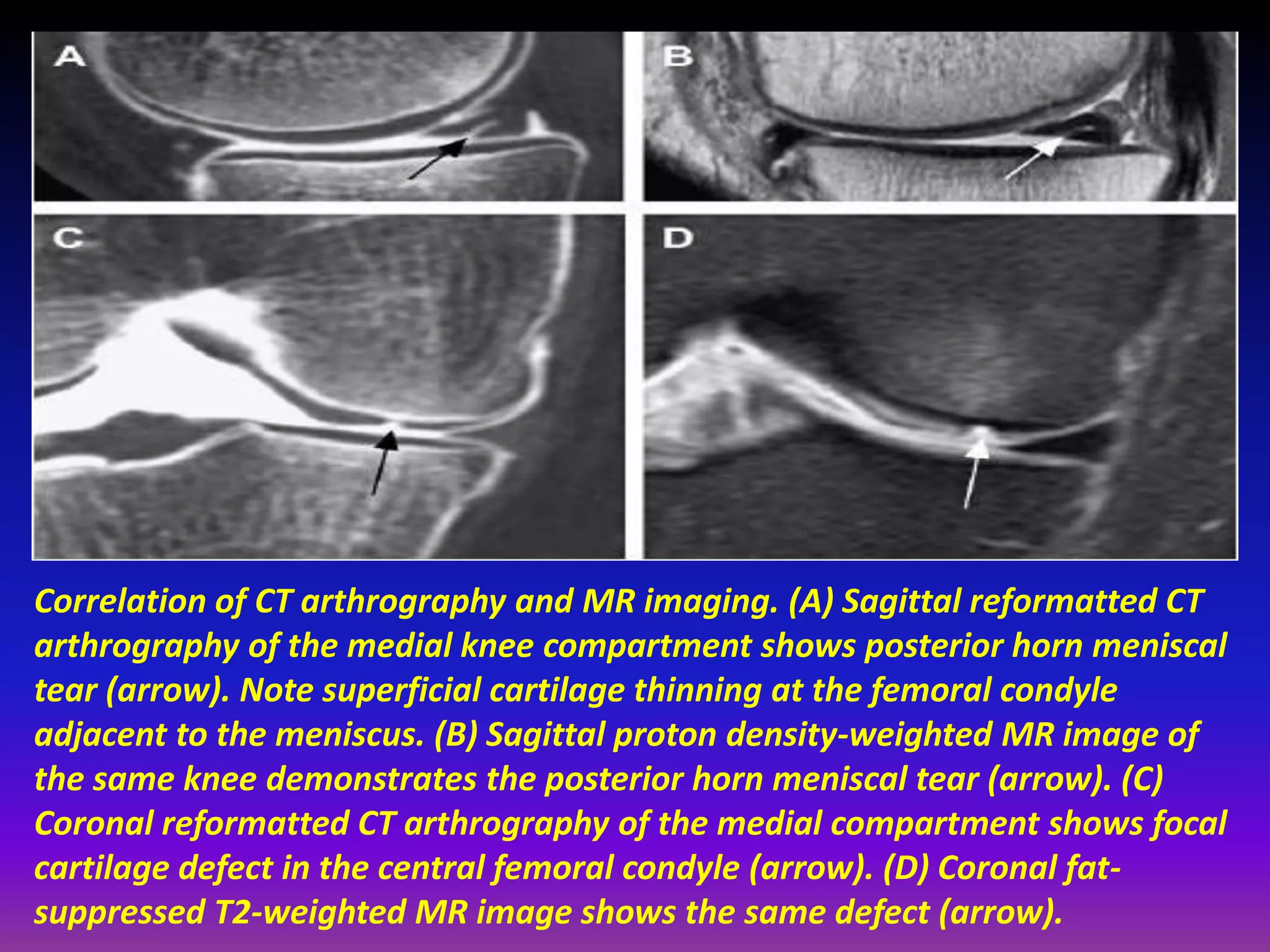 Correlation of CT arthrography and MR imaging. (A) Sagittal reformatted CT
arthrography of the medial knee compartment shows posterior horn meniscal
tear (arrow). Note superficial cartilage thinning at the femoral condyle
adjacent to the meniscus. (B) Sagittal proton density-weighted MR image of
the same knee demonstrates the posterior horn meniscal tear (arrow). (C)
Coronal reformatted CT arthrography of the medial compartment shows focal
cartilage defect in the central femoral condyle (arrow). (D) Coronal fat-
suppressed T2-weighted MR image shows the same defect (arrow).
 