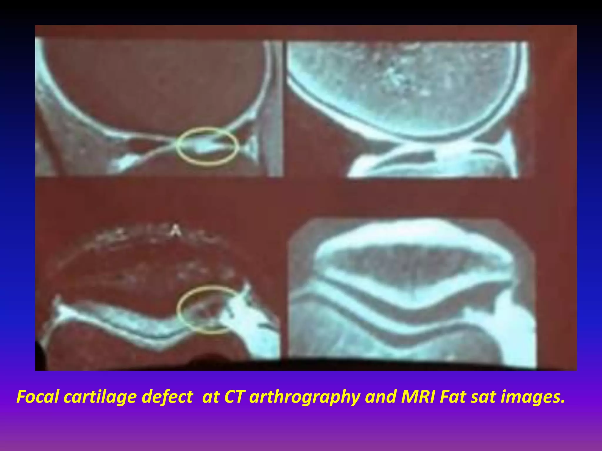 Focal cartilage defect at CT arthrography and MRI Fat sat images.
 