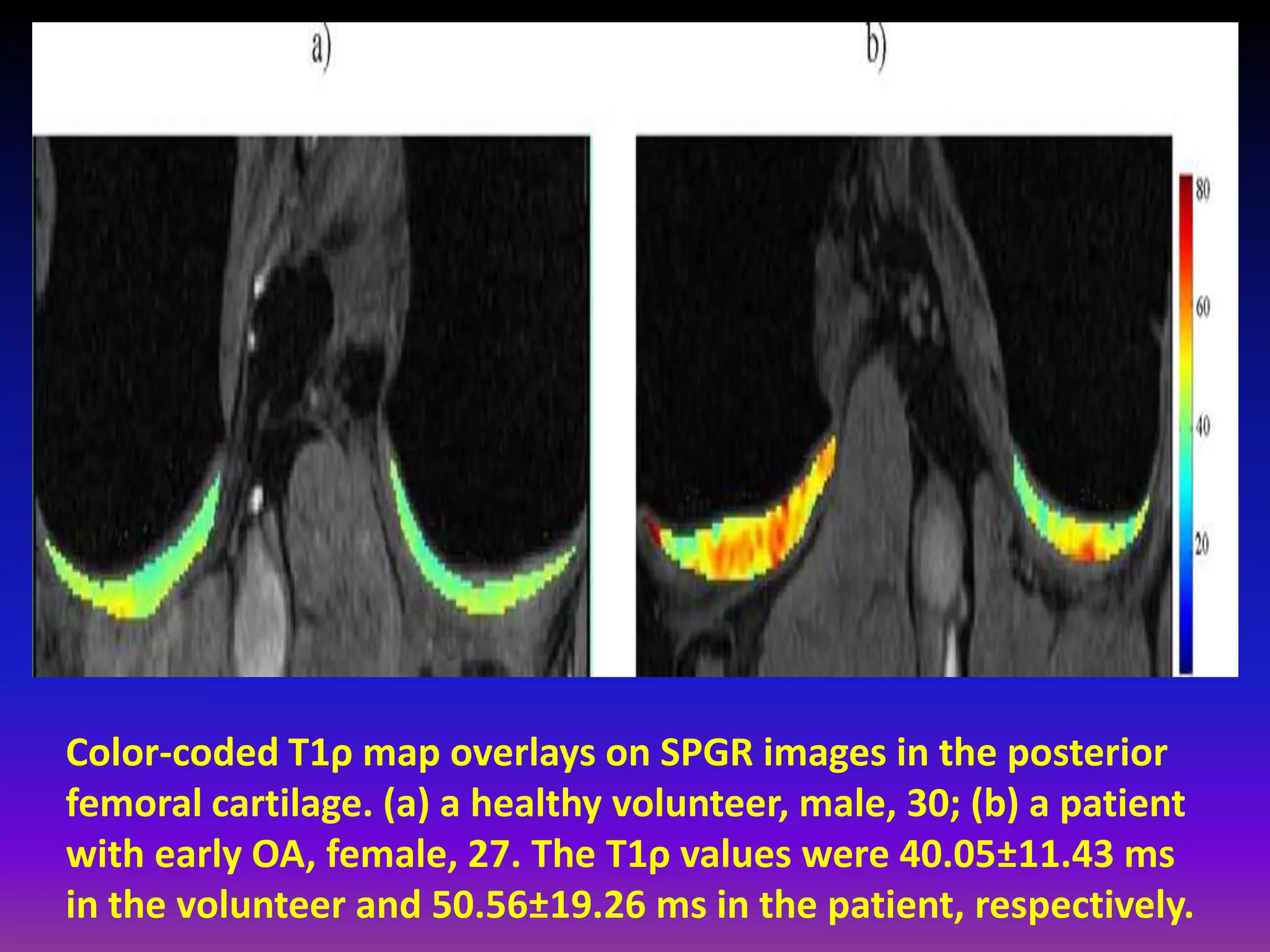 Color-coded T1ρ map overlays on SPGR images in the posterior
femoral cartilage. (a) a healthy volunteer, male, 30; (b) a patient
with early OA, female, 27. The T1ρ values were 40.05±11.43 ms
in the volunteer and 50.56±19.26 ms in the patient, respectively.
 
