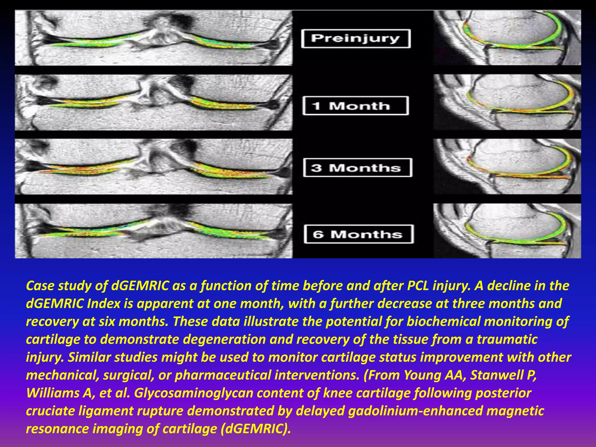 Case study of dGEMRIC as a function of time before and after PCL injury. A decline in the
dGEMRIC Index is apparent at one month, with a further decrease at three months and
recovery at six months. These data illustrate the potential for biochemical monitoring of
cartilage to demonstrate degeneration and recovery of the tissue from a traumatic
injury. Similar studies might be used to monitor cartilage status improvement with other
mechanical, surgical, or pharmaceutical interventions. (From Young AA, Stanwell P,
Williams A, et al. Glycosaminoglycan content of knee cartilage following posterior
cruciate ligament rupture demonstrated by delayed gadolinium-enhanced magnetic
resonance imaging of cartilage (dGEMRIC).
 