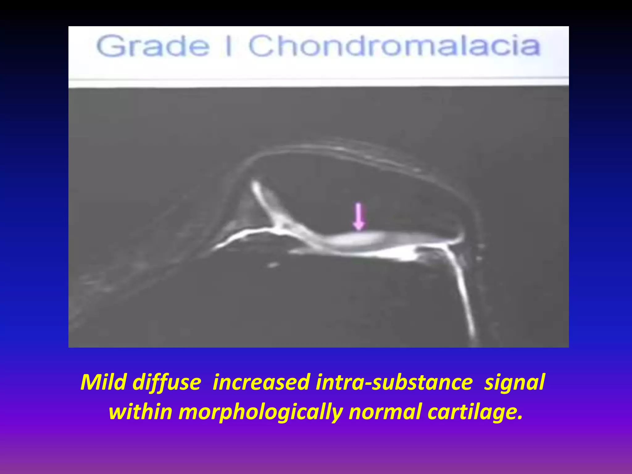 Mild diffuse increased intra-substance signal
within morphologically normal cartilage.
 