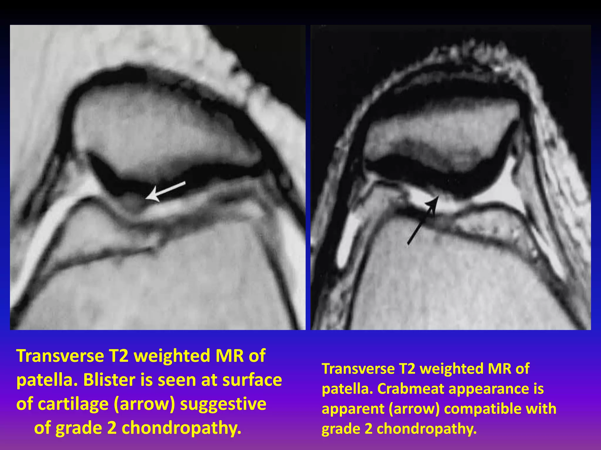 Transverse T2 weighted MR of
patella. Blister is seen at surface
of cartilage (arrow) suggestive
of grade 2 chondropathy.
Transverse T2 weighted MR of
patella. Crabmeat appearance is
apparent (arrow) compatible with
grade 2 chondropathy.
 