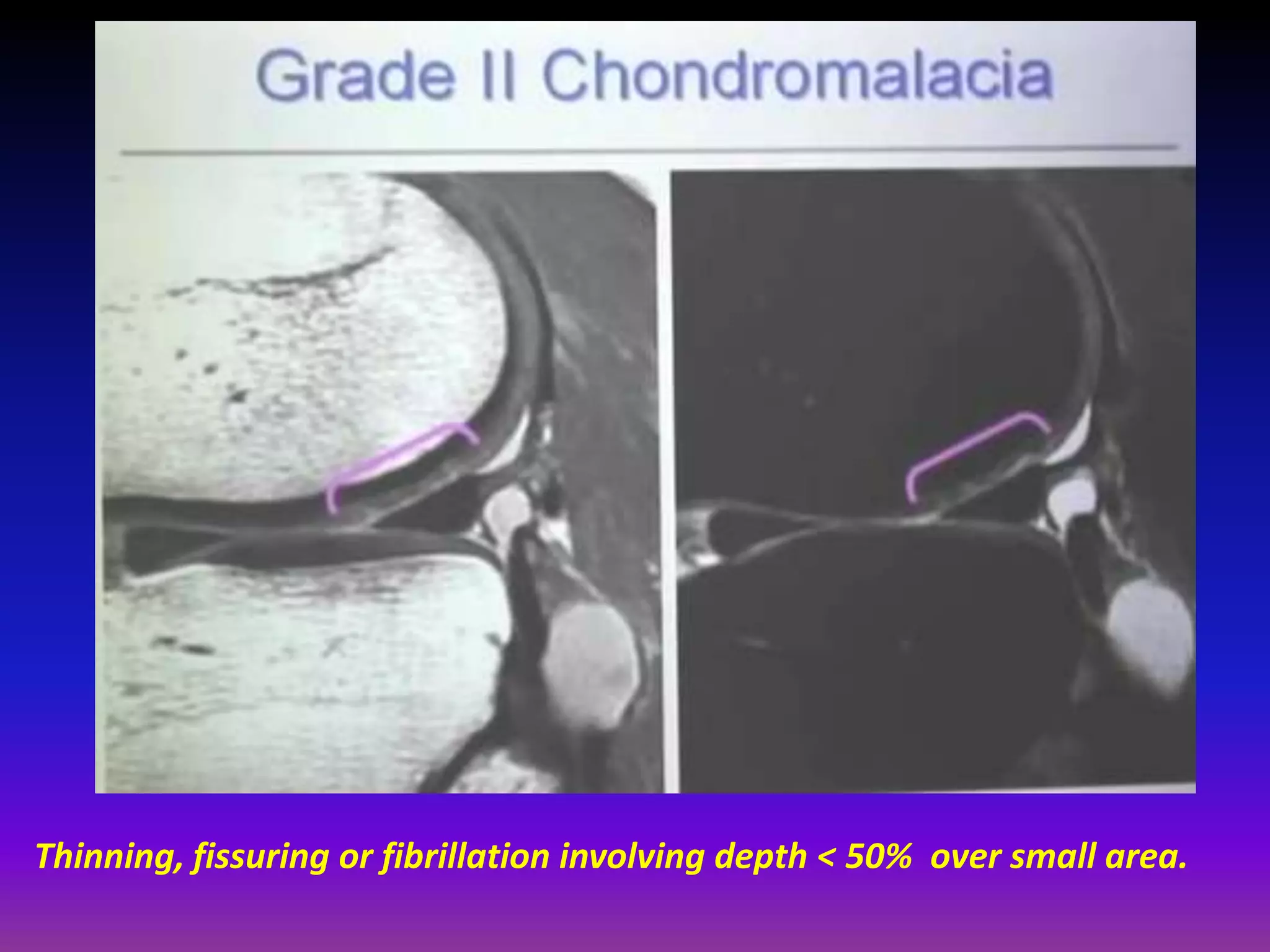 Thinning, fissuring or fibrillation involving depth < 50% over small area.
 