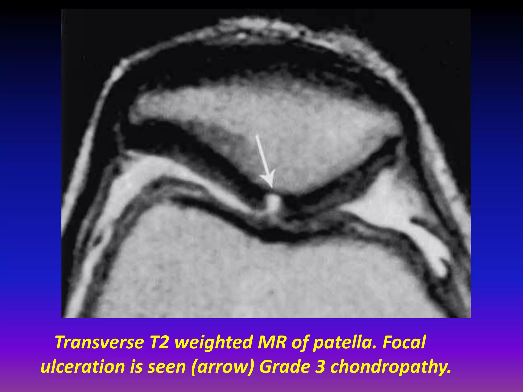 Transverse T2 weighted MR of patella. Focal
ulceration is seen (arrow) Grade 3 chondropathy.
 
