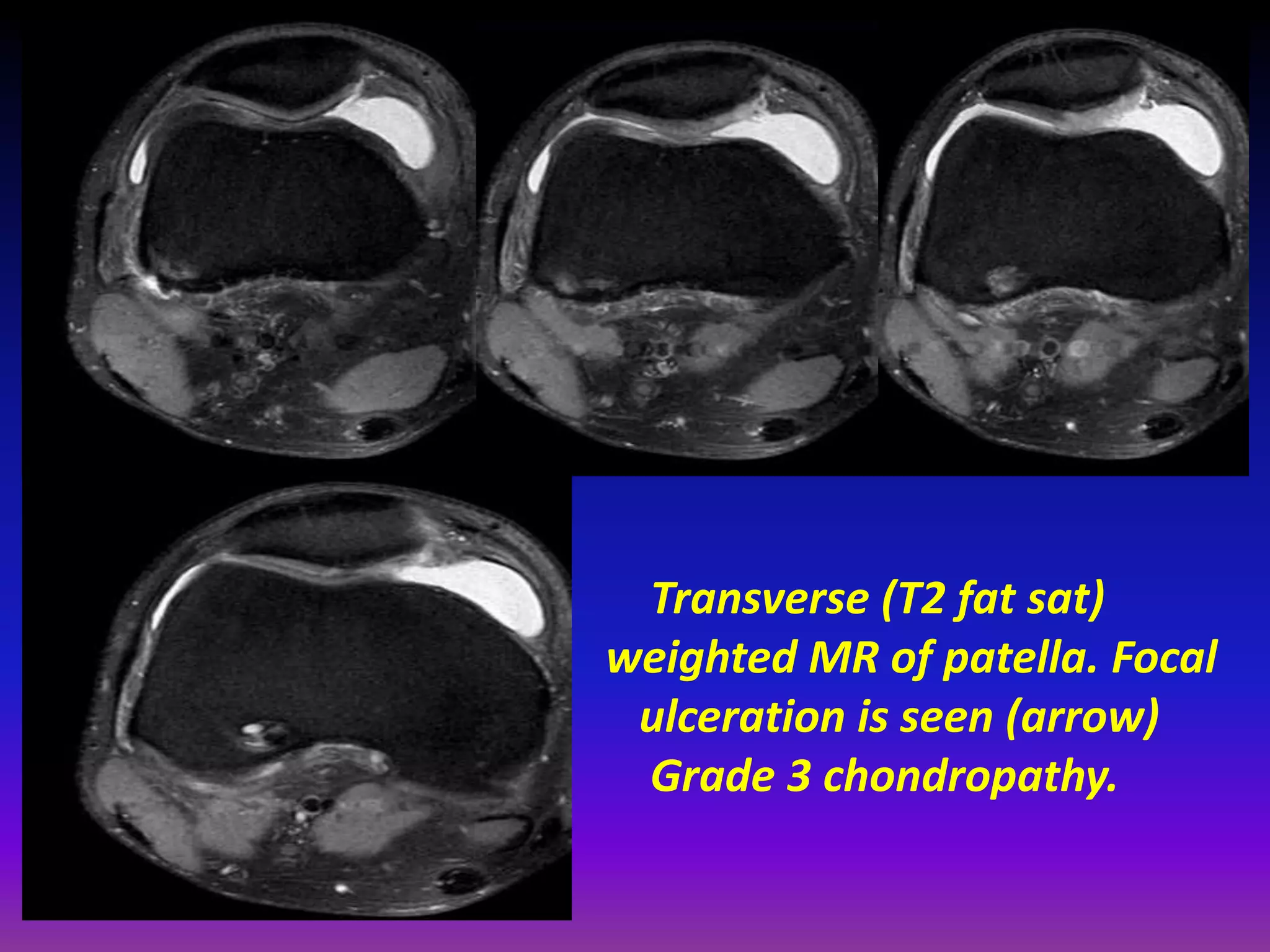 Transverse (T2 fat sat)
weighted MR of patella. Focal
ulceration is seen (arrow)
Grade 3 chondropathy.
 
