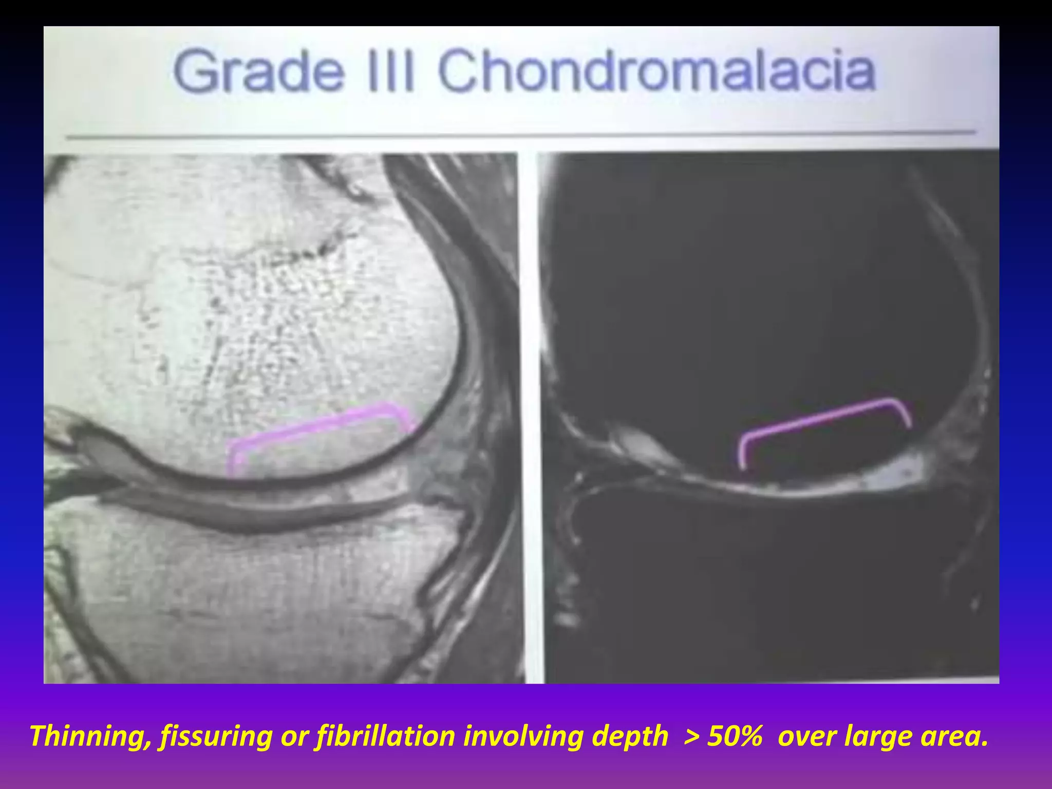 Thinning, fissuring or fibrillation involving depth > 50% over large area.
 