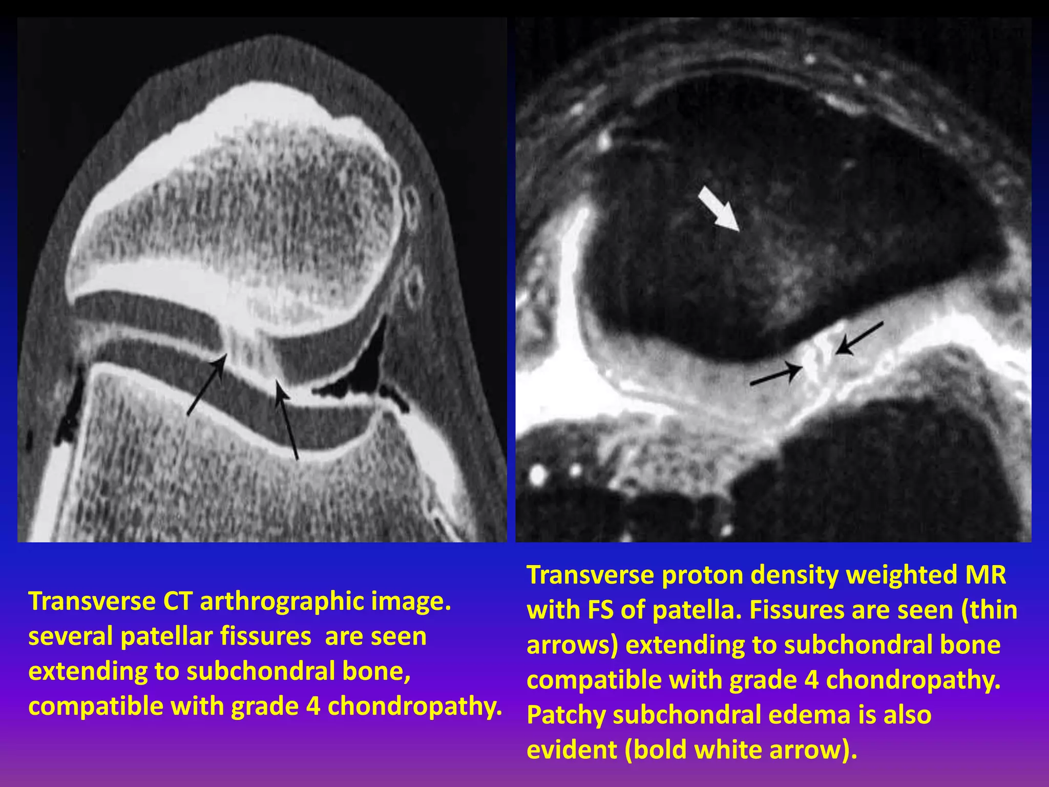 Transverse CT arthrographic image.
several patellar fissures are seen
extending to subchondral bone,
compatible with grade 4 chondropathy.
Transverse proton density weighted MR
with FS of patella. Fissures are seen (thin
arrows) extending to subchondral bone
compatible with grade 4 chondropathy.
Patchy subchondral edema is also
evident (bold white arrow).
 
