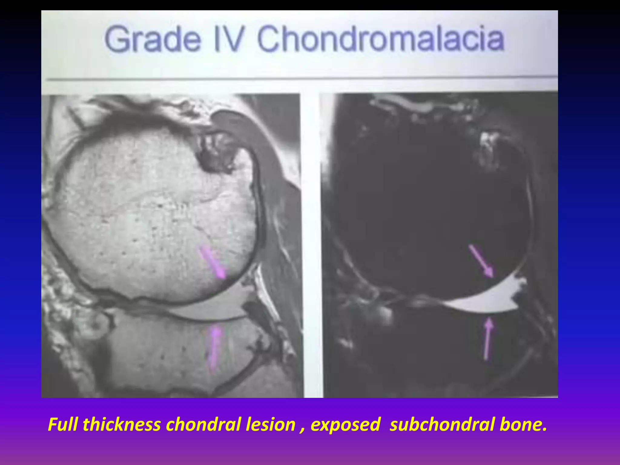 Full thickness chondral lesion , exposed subchondral bone.
 