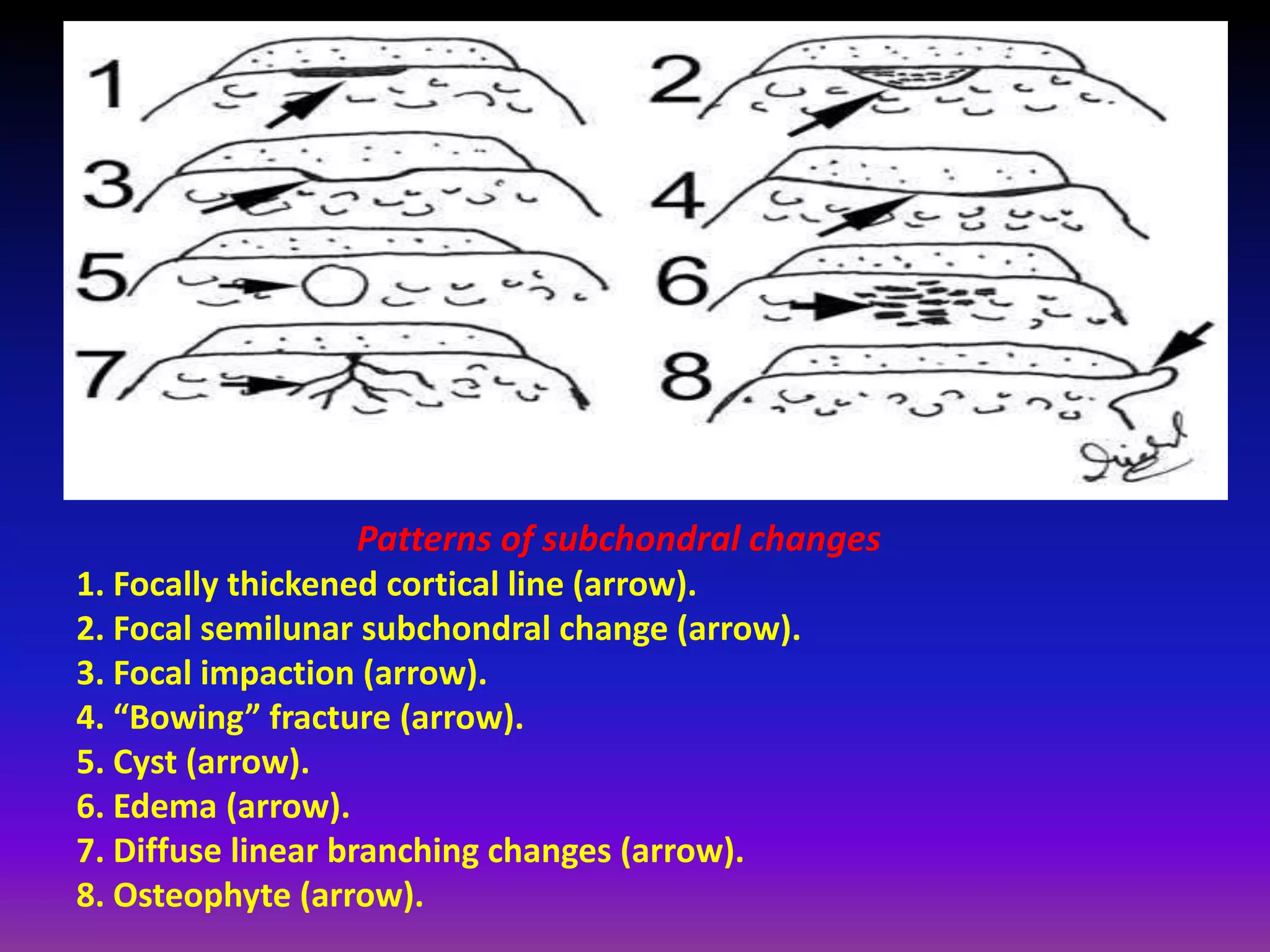 Patterns of subchondral changes
1. Focally thickened cortical line (arrow).
2. Focal semilunar subchondral change (arrow).
3. Focal impaction (arrow).
4. “Bowing” fracture (arrow).
5. Cyst (arrow).
6. Edema (arrow).
7. Diffuse linear branching changes (arrow).
8. Osteophyte (arrow).
 
