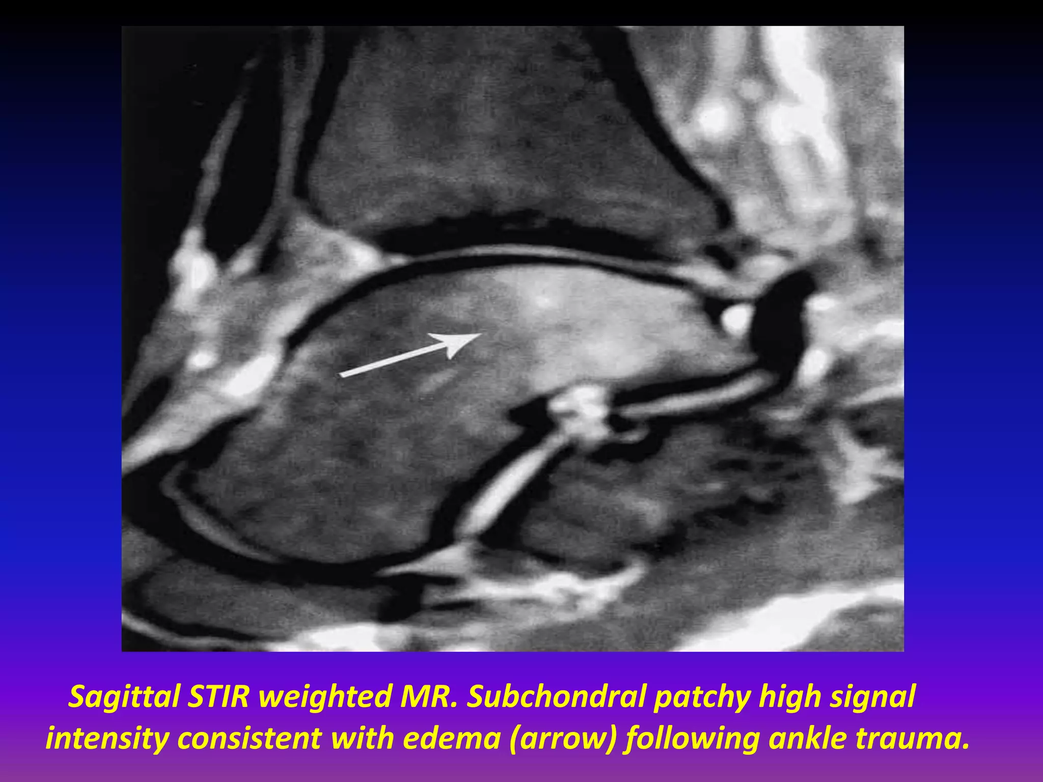 Sagittal STIR weighted MR. Subchondral patchy high signal
intensity consistent with edema (arrow) following ankle trauma.
 