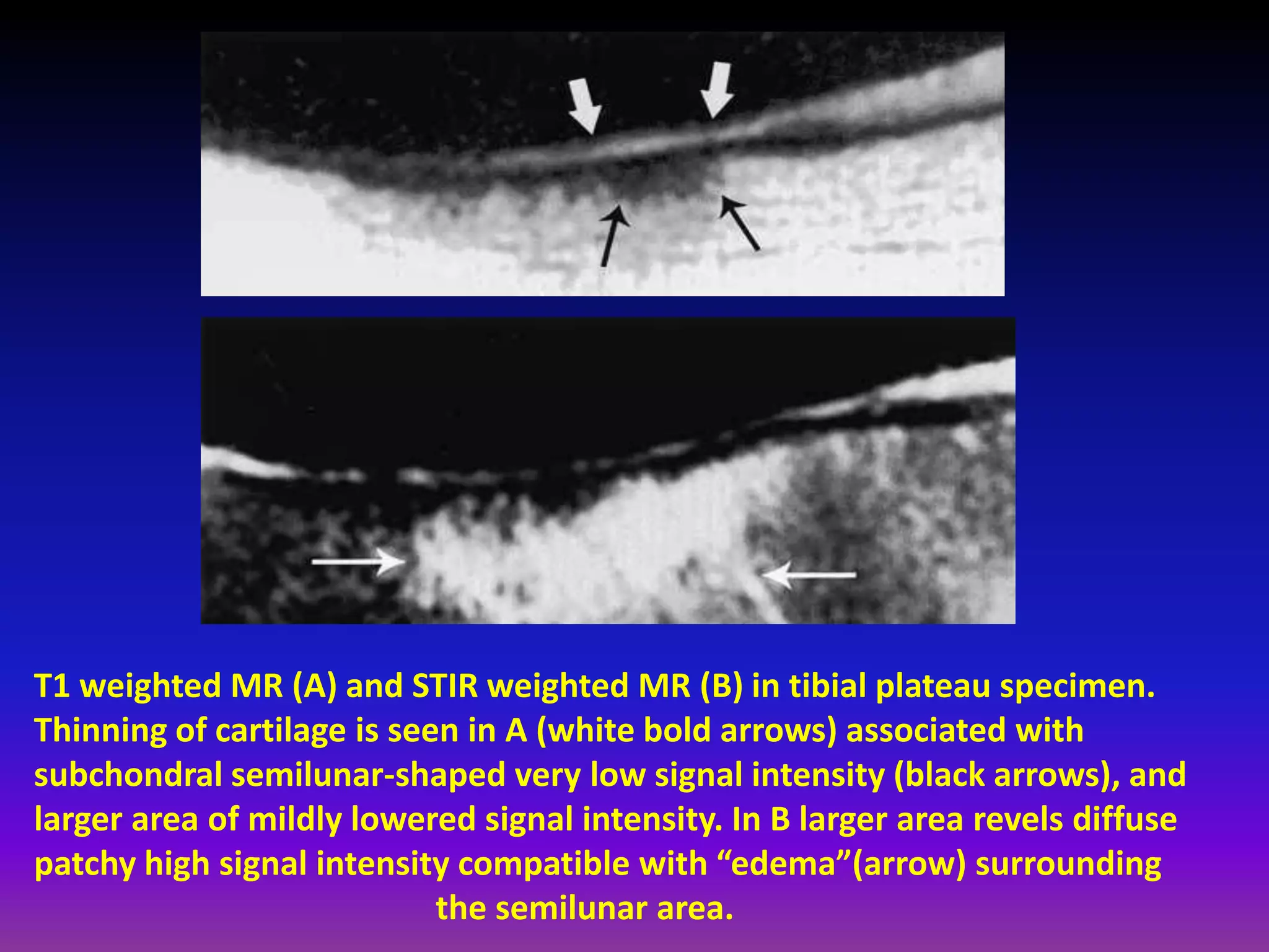 T1 weighted MR (A) and STIR weighted MR (B) in tibial plateau specimen.
Thinning of cartilage is seen in A (white bold arrows) associated with
subchondral semilunar-shaped very low signal intensity (black arrows), and
larger area of mildly lowered signal intensity. In B larger area revels diffuse
patchy high signal intensity compatible with “edema”(arrow) surrounding
the semilunar area.
 