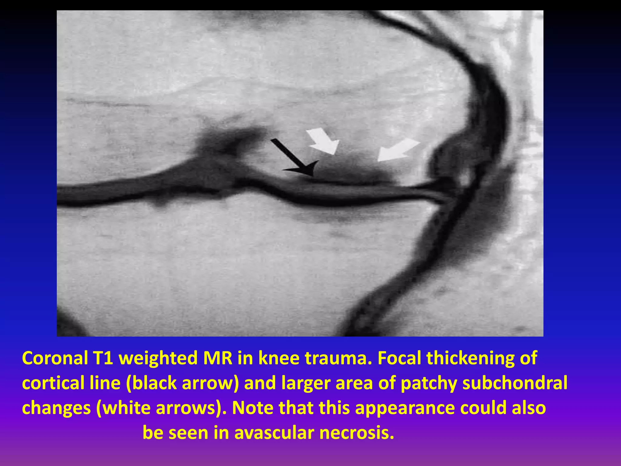 Coronal T1 weighted MR in knee trauma. Focal thickening of
cortical line (black arrow) and larger area of patchy subchondral
changes (white arrows). Note that this appearance could also
be seen in avascular necrosis.
 