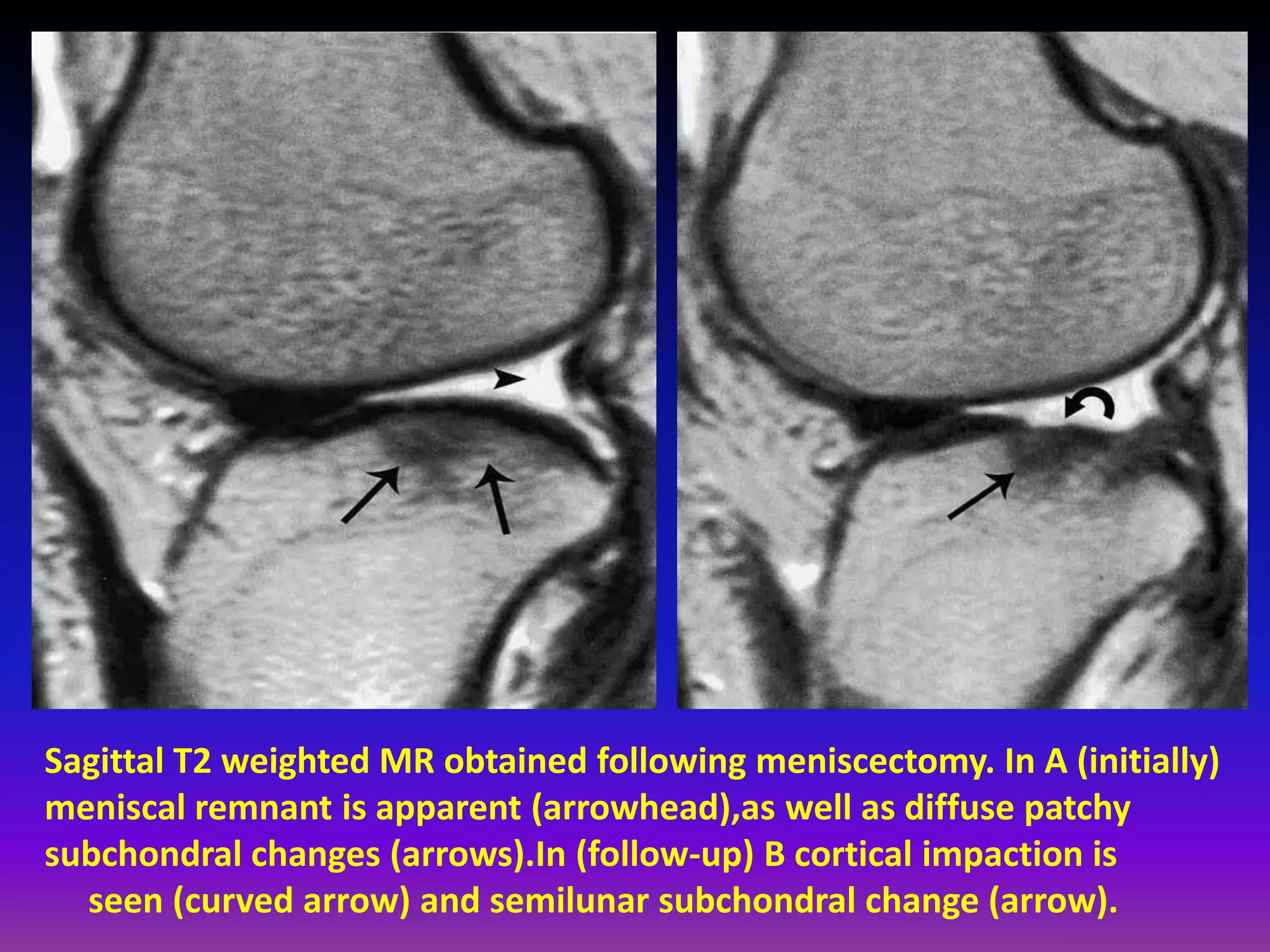 Sagittal T2 weighted MR obtained following meniscectomy. In A (initially)
meniscal remnant is apparent (arrowhead),as well as diffuse patchy
subchondral changes (arrows).In (follow-up) B cortical impaction is
seen (curved arrow) and semilunar subchondral change (arrow).
 