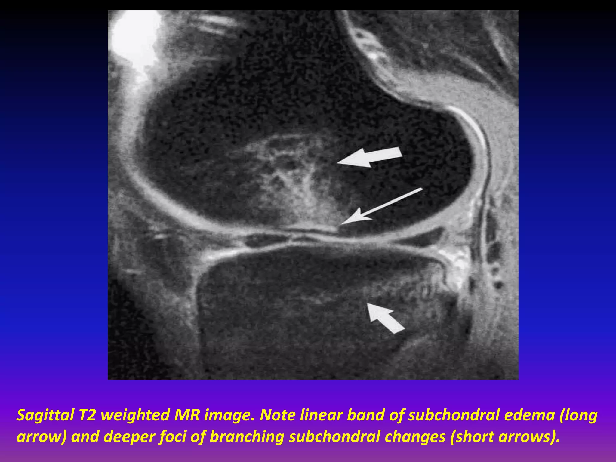 Sagittal T2 weighted MR image. Note linear band of subchondral edema (long
arrow) and deeper foci of branching subchondral changes (short arrows).
 