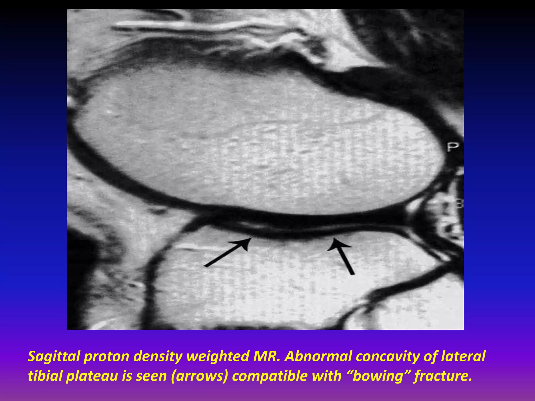 Sagittal proton density weighted MR. Abnormal concavity of lateral
tibial plateau is seen (arrows) compatible with “bowing” fracture.
 