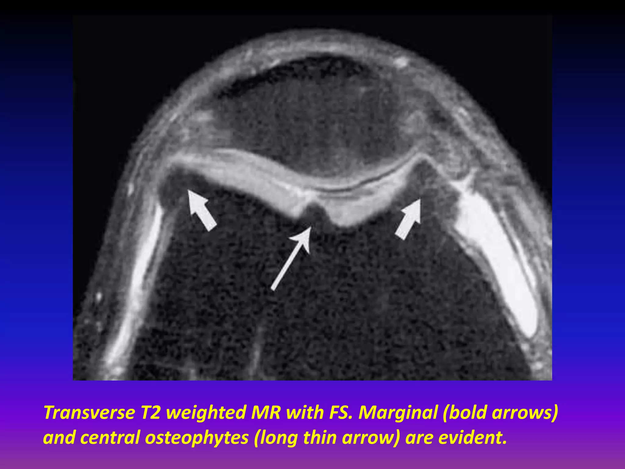 Transverse T2 weighted MR with FS. Marginal (bold arrows)
and central osteophytes (long thin arrow) are evident.
 
