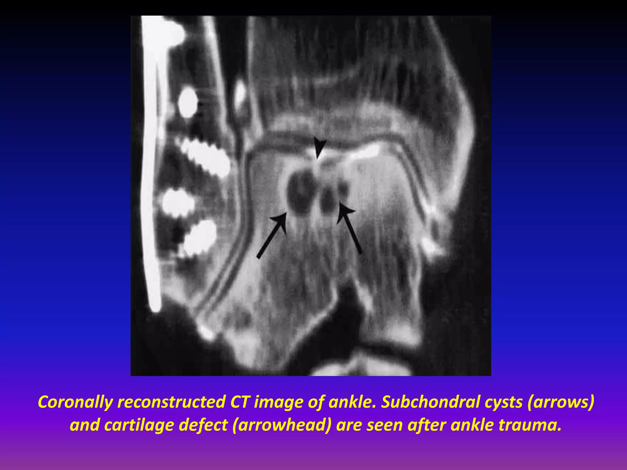 Coronally reconstructed CT image of ankle. Subchondral cysts (arrows)
and cartilage defect (arrowhead) are seen after ankle trauma.
 
