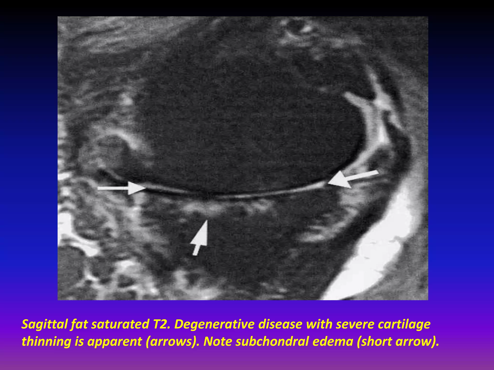 Sagittal fat saturated T2. Degenerative disease with severe cartilage
thinning is apparent (arrows). Note subchondral edema (short arrow).
 