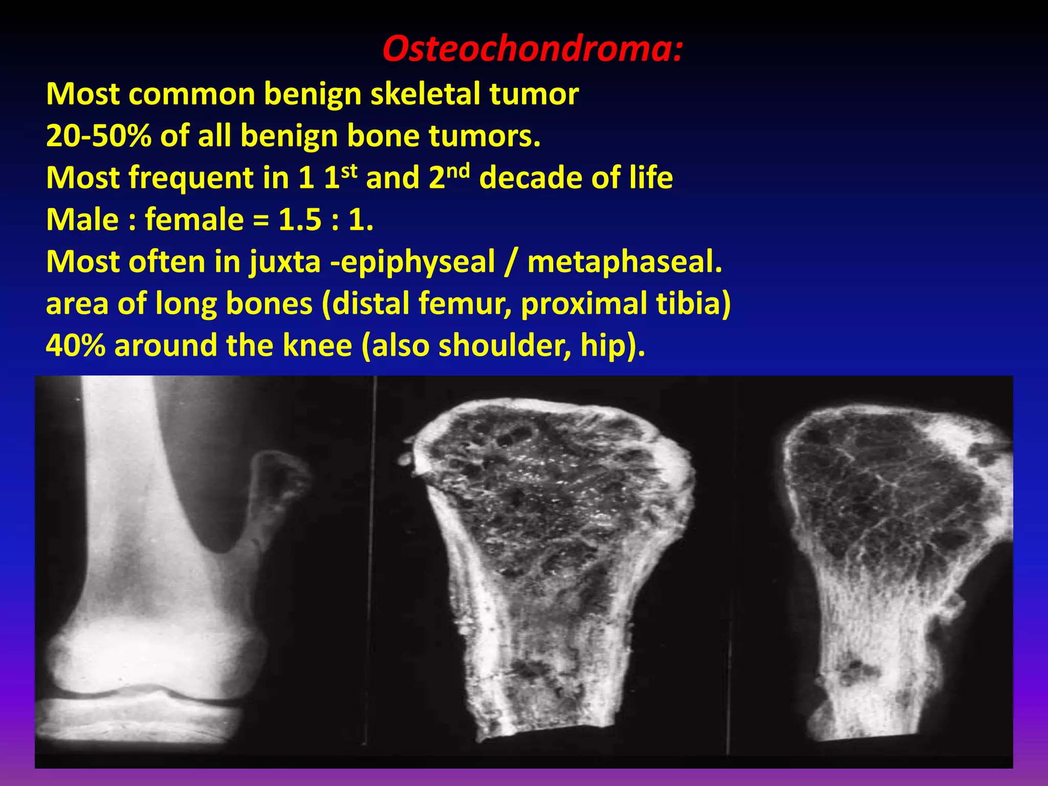 Osteochondroma:
Most common benign skeletal tumor
20-50% of all benign bone tumors.
Most frequent in 1 1st and 2nd decade of life
Male : female = 1.5 : 1.
Most often in juxta -epiphyseal / metaphaseal.
area of long bones (distal femur, proximal tibia)
40% around the knee (also shoulder, hip).
 