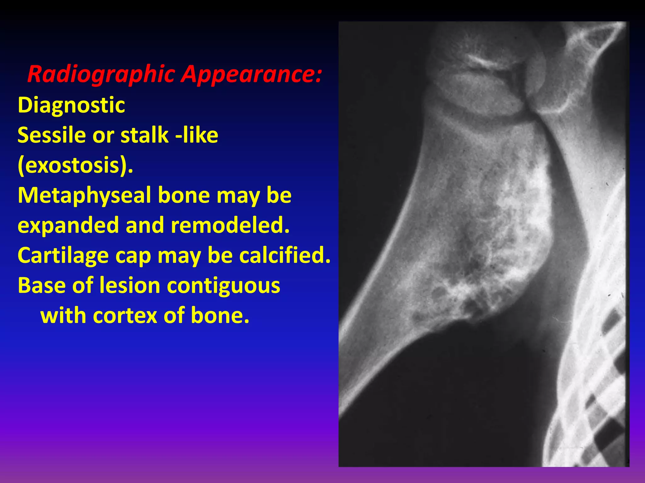 Radiographic Appearance:
Diagnostic
Sessile or stalk -like
(exostosis).
Metaphyseal bone may be
expanded and remodeled.
Cartilage cap may be calcified.
Base of lesion contiguous
with cortex of bone.
 
