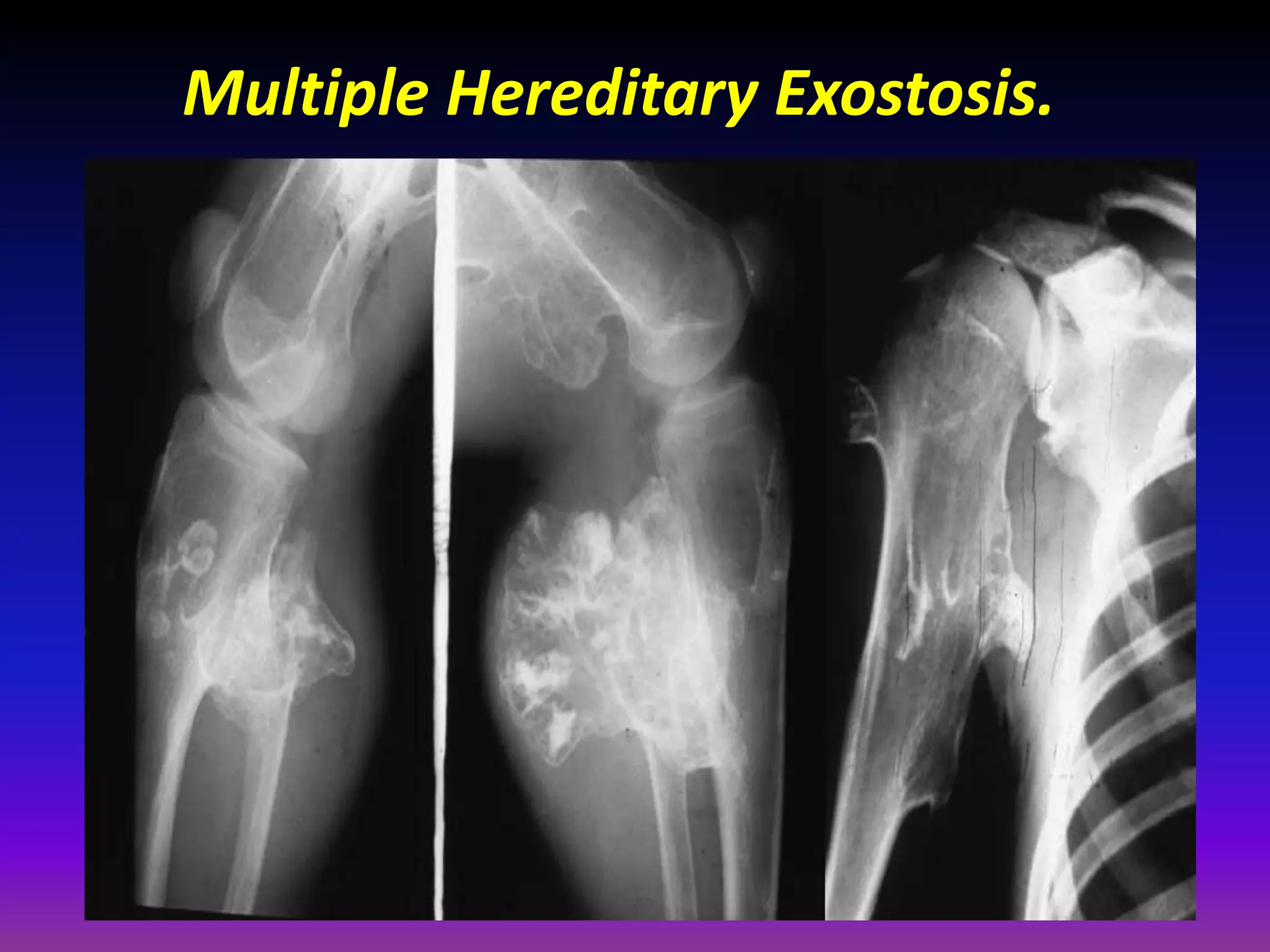 Multiple Hereditary Exostosis.
 
