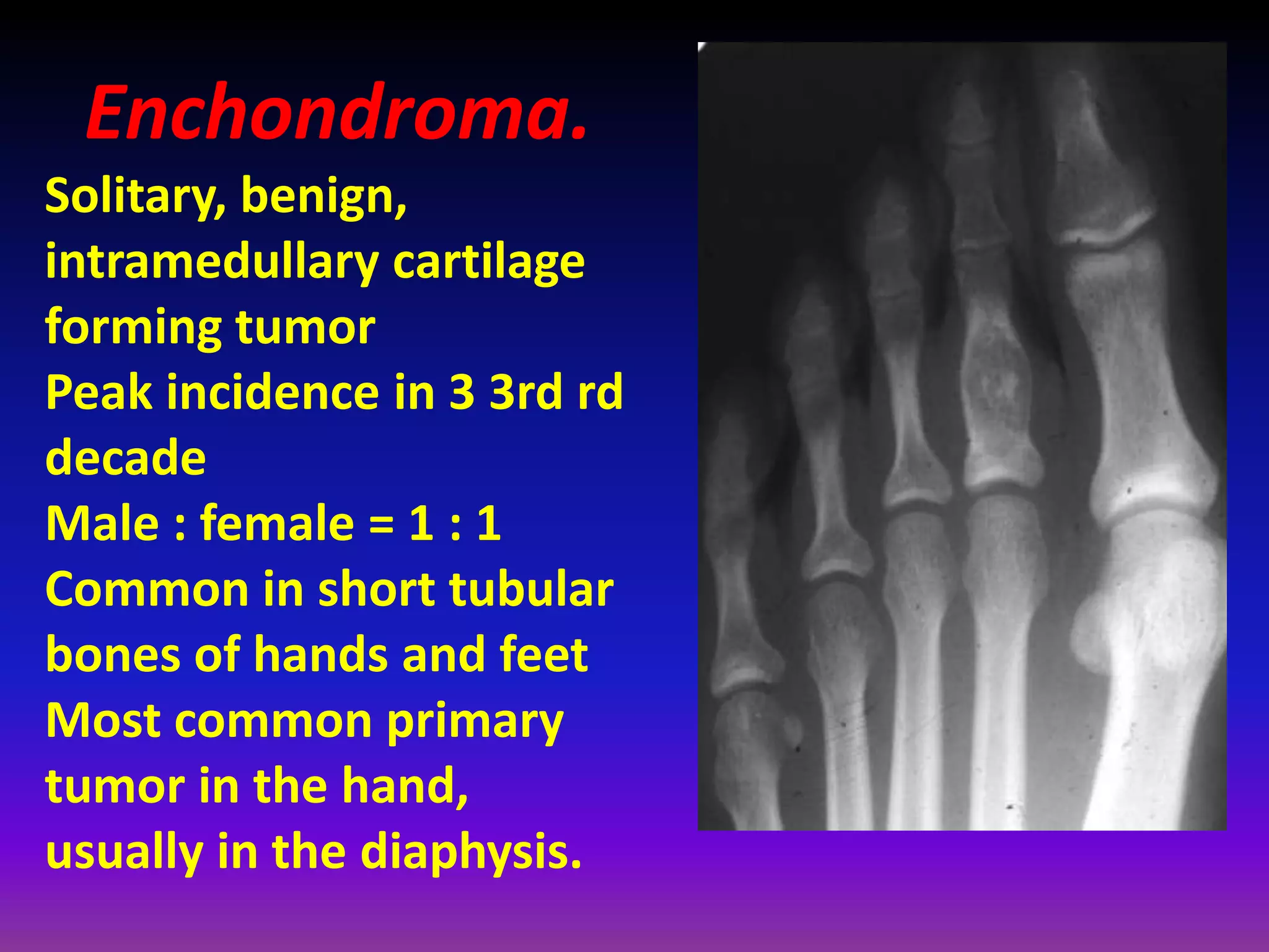 Enchondroma.
Solitary, benign,
intramedullary cartilage
forming tumor
Peak incidence in 3 3rd rd
decade
Male : female = 1 : 1
Common in short tubular
bones of hands and feet
Most common primary
tumor in the hand,
usually in the diaphysis.
 