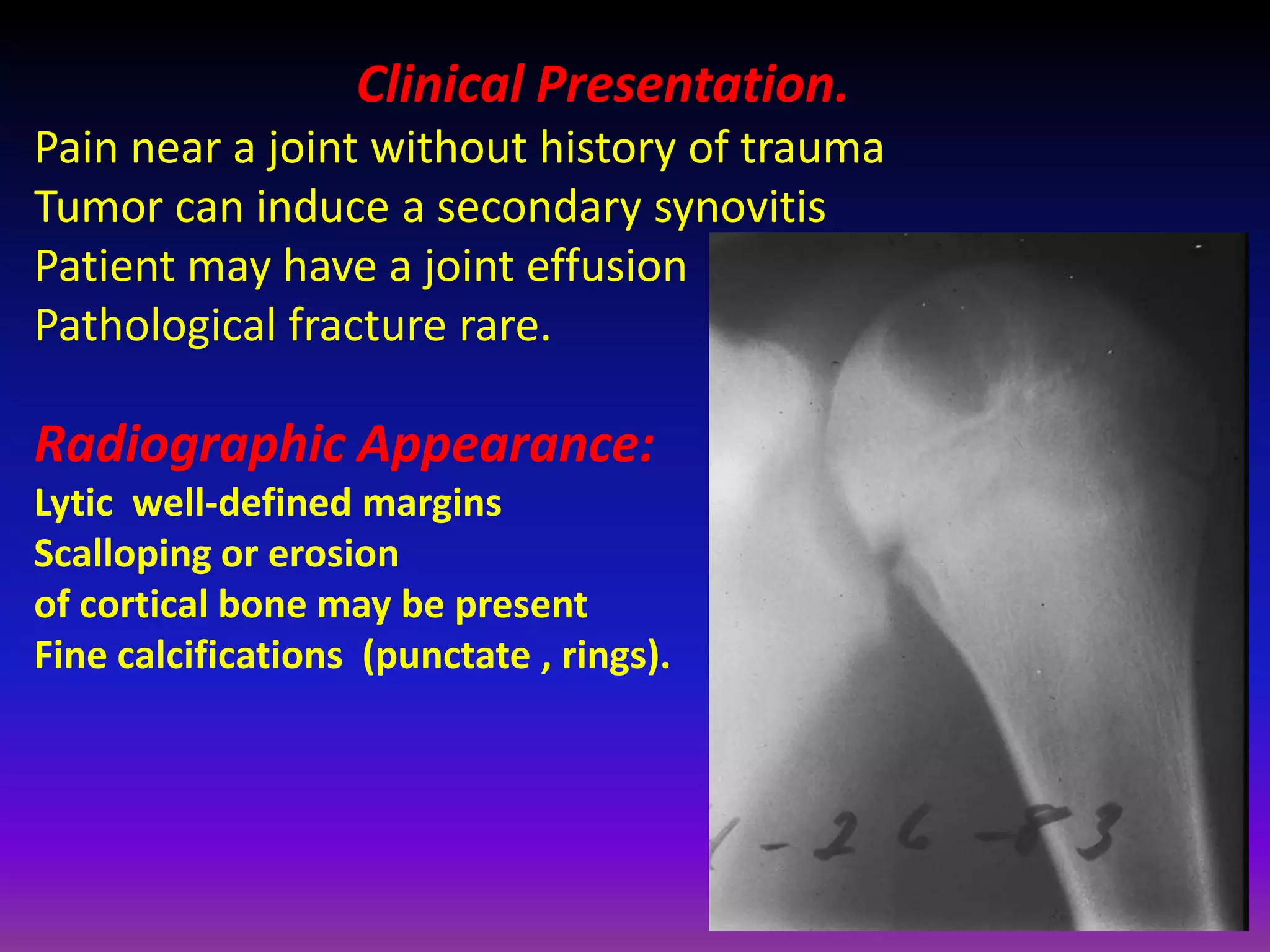 Clinical Presentation.
Pain near a joint without history of trauma
Tumor can induce a secondary synovitis
Patient may have a joint effusion
Pathological fracture rare.
Radiographic Appearance:
Lytic well-defined margins
Scalloping or erosion
of cortical bone may be present
Fine calcifications (punctate , rings).
 