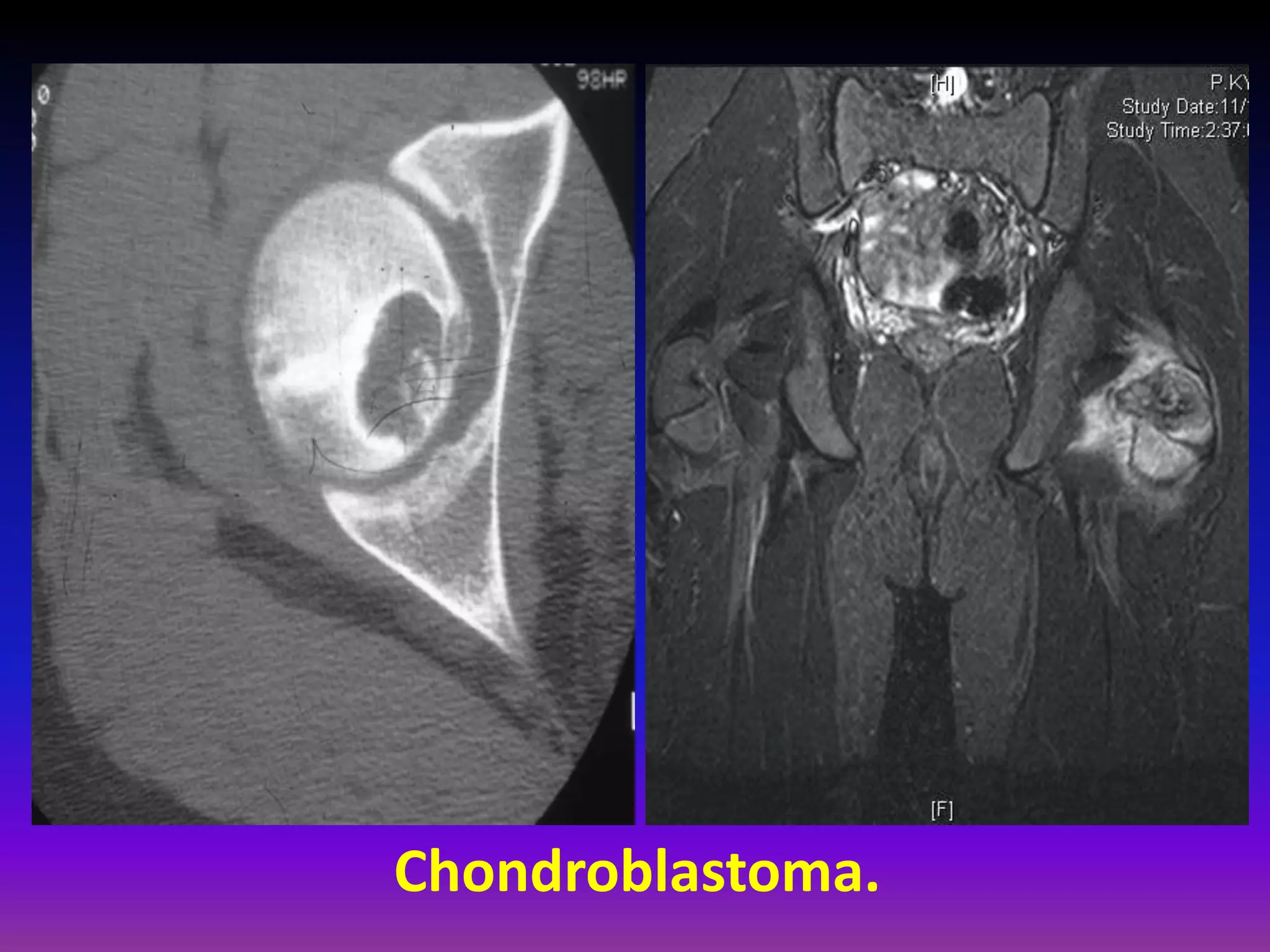 Chondroblastoma.
 