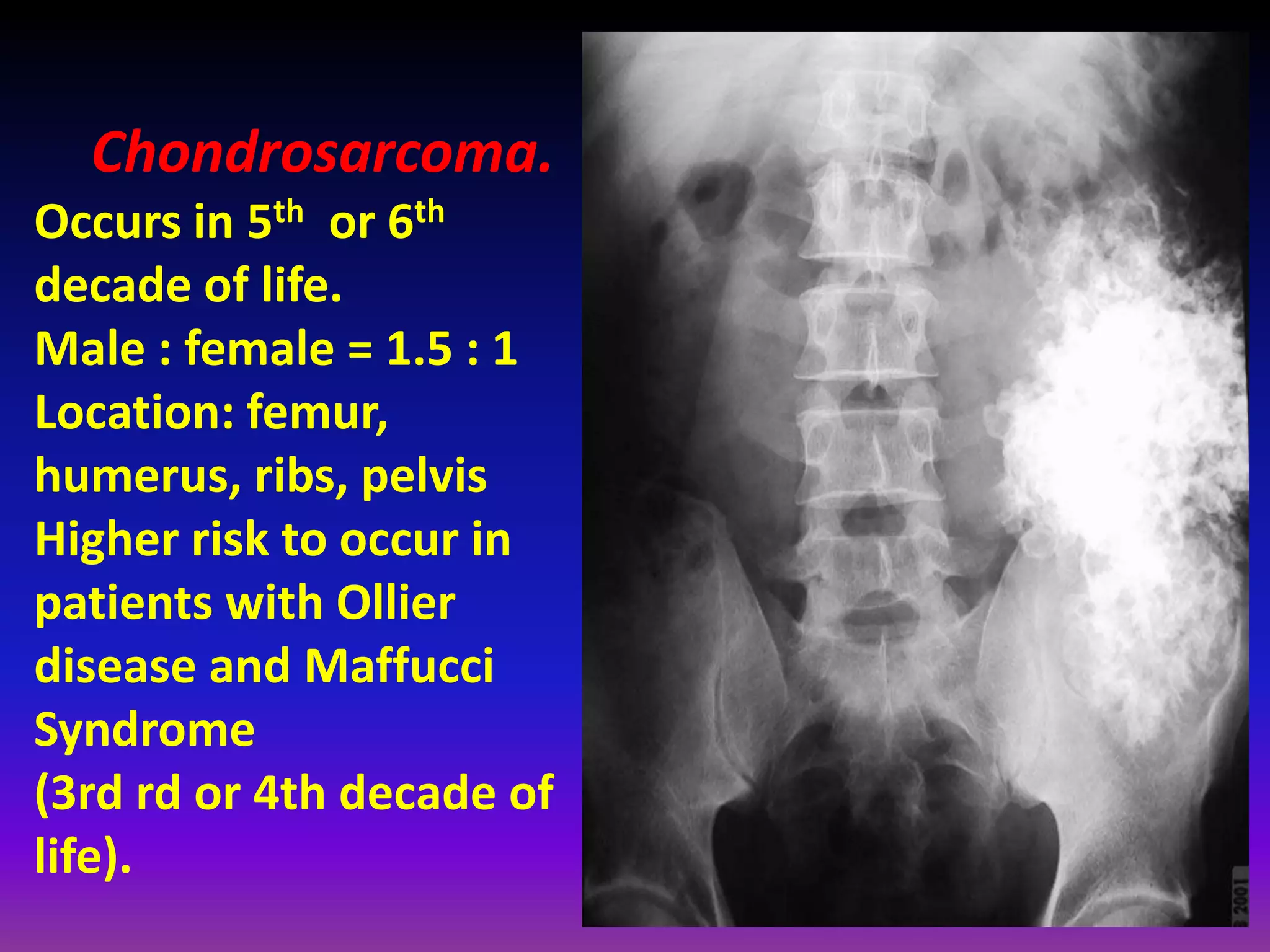 Chondrosarcoma.
Occurs in 5th or 6th
decade of life.
Male : female = 1.5 : 1
Location: femur,
humerus, ribs, pelvis
Higher risk to occur in
patients with Ollier
disease and Maffucci
Syndrome
(3rd rd or 4th decade of
life).
 