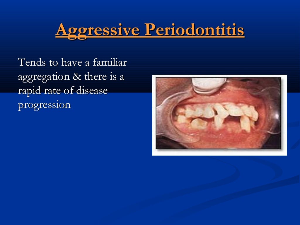 Aggressive Periodontitis