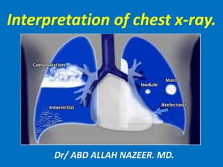 Interpretation of chest x-ray.
Dr/ ABD ALLAH NAZEER. MD.
 