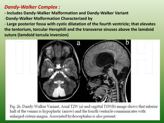 Torcular Inversion Presentation1.pptx, congenital malformation of the brain. | PPTX