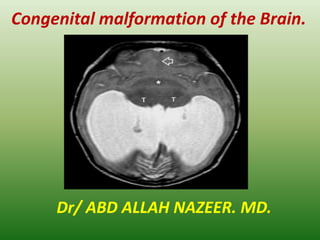 Congenital malformation of the Brain.
Dr/ ABD ALLAH NAZEER. MD.
 