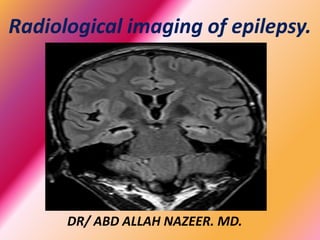 Radiological imaging of epilepsy.
DR/ ABD ALLAH NAZEER. MD.
 