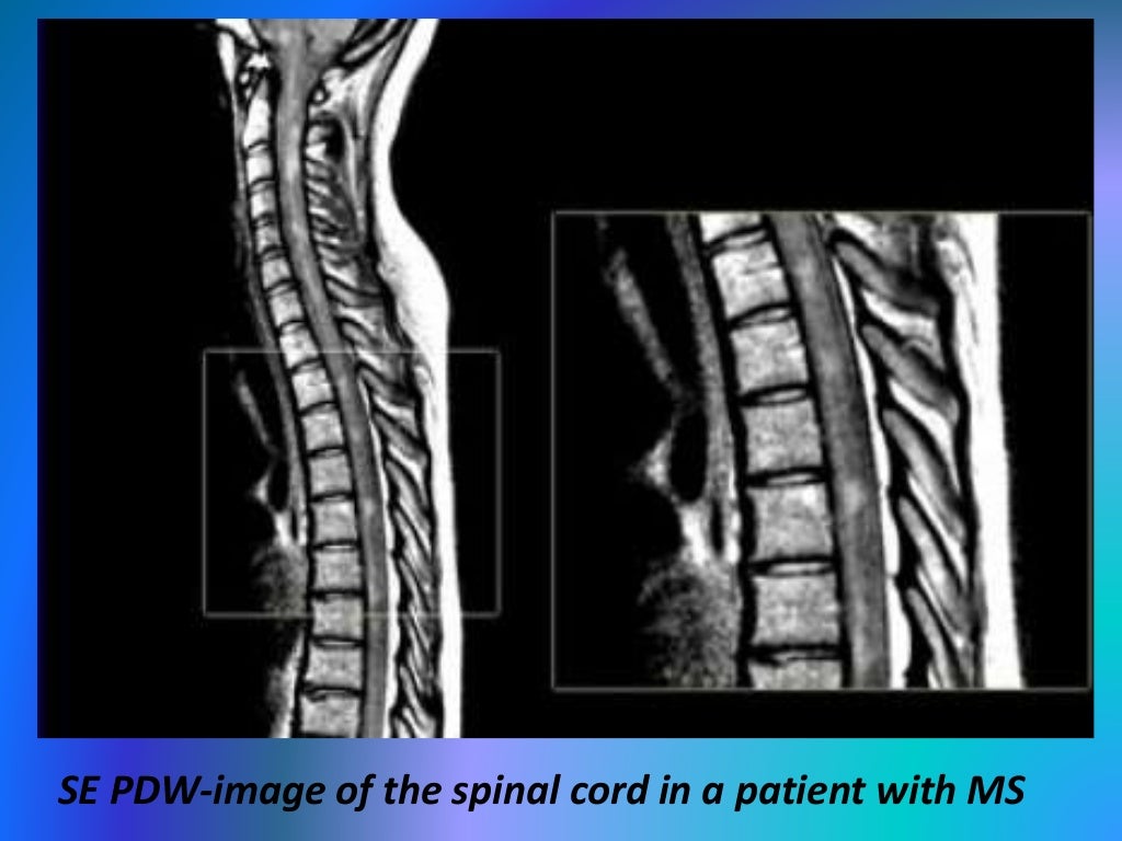 Presentation1.pptx, imaging of multiple sclerosis.