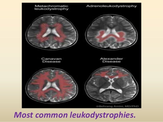 Presentation1 Pptx White Matter Disorder In Pediatric