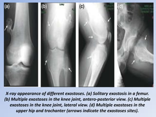 Presentation1.pptx, interpretation of x ray on bone tumour. | PPTX