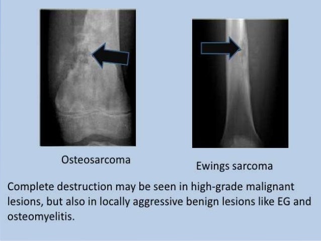 El sarcoma de ewing es curable